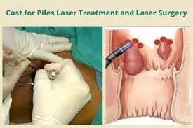 LASER TREATMENT FOR PILES, FISSURE, FISTULA etc. image 1