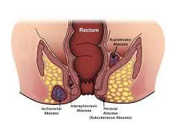 FISTULA image 1