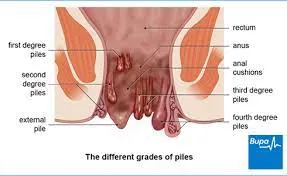 PILES image 1