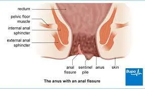 ANAL FISSURE image 1