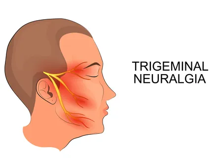Nonsurgical Treatment of Trigeminal Neuralgia Clinic in Pune image 1