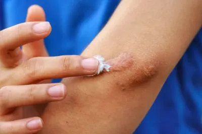 Keloids Treatment image 1