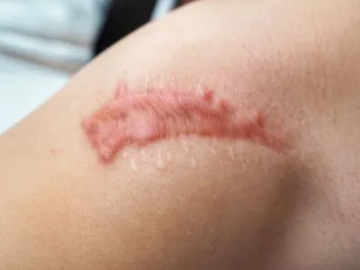 Keloids Treatment image 3
