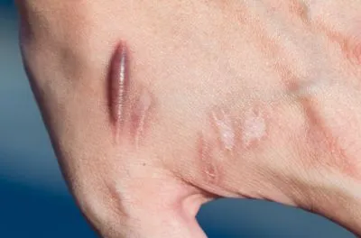 Keloids Treatment image 2