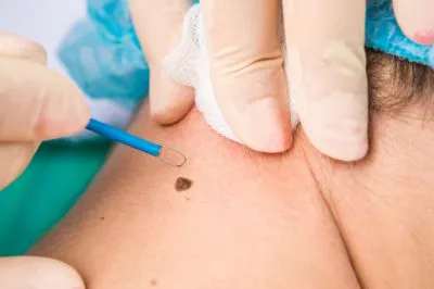 Mole Removal image 1