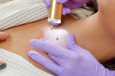 Laser Treatment For Birthmarks image 1