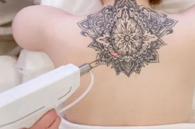 Tattoo Removal image 1