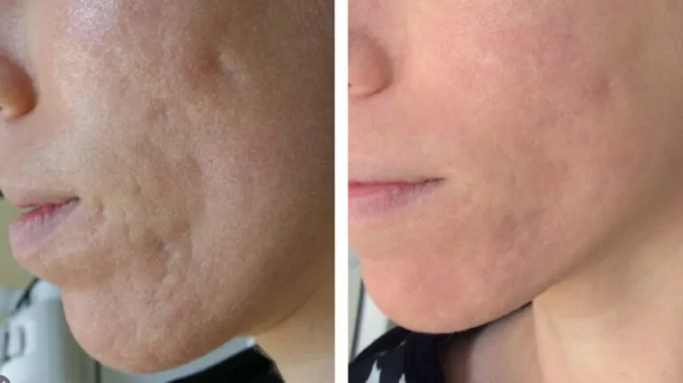 Scar Laser/ CO2 Laser/ MnRF image 2