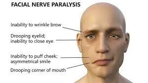 Facial Nerve Disorders image 1