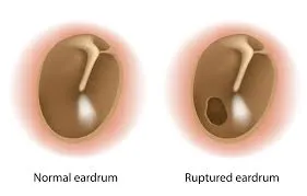 Perforated Ear Drum image 1
