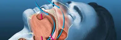 Snoring Evaluation image 1
