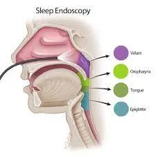 Sleep Endoscopy image 1