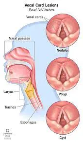 Voice Surgeries (Cord Tumor)  image 1