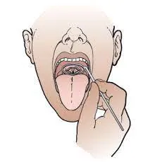 Voice Surgeries (Cord Palsy)  image 1