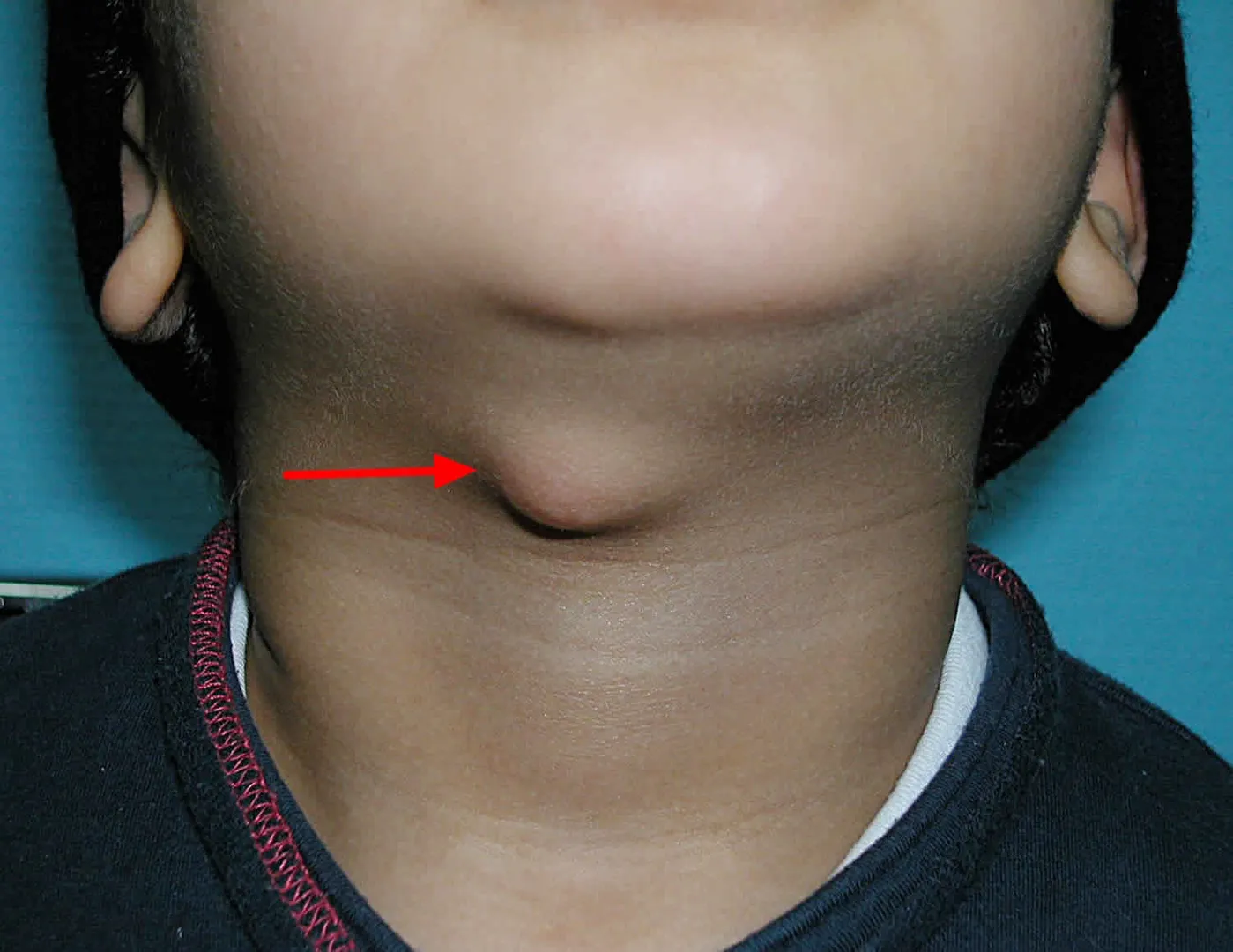 Thyroglossal Cyst image 1