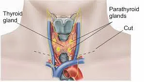Thyroidectomy image 1