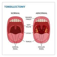 Tonsillectomy image 1