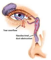 Endoscopic Dacrocystorhinostomy  image 1