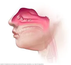 Nasal Polyposis image 1