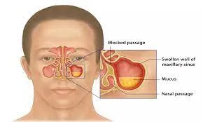 Allergic Fungal Rhinosinusitis image 1