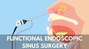 Endoscopic Sinus Surgeries image 1