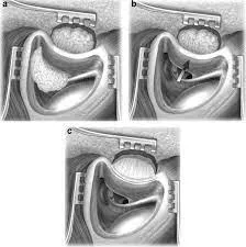 Posterior Tympanotomy image 1
