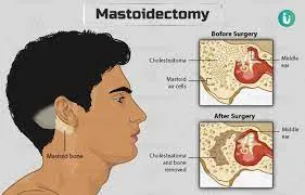 Modified Radical Mastoidectomy image 1