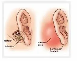 Cortical Mastoidectomy image 1