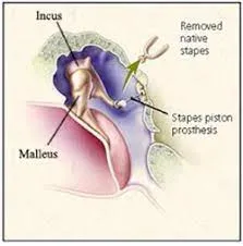 Ossiculoplasty image 1
