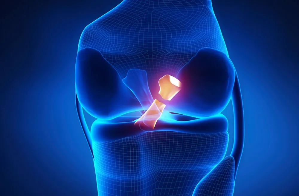 PCL treatment image 1