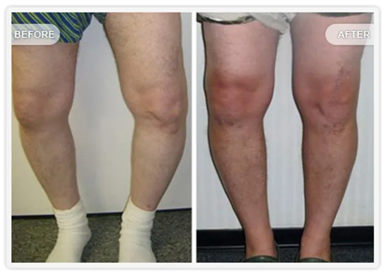 Joint replacement treatment image 2
