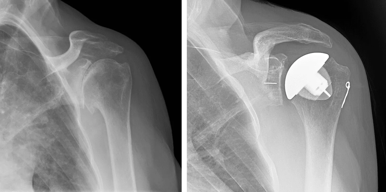 Shoulder Replacement Surgery image 1