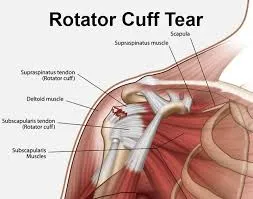 Rotator Cuff Tear image 1