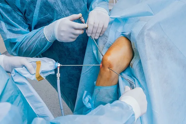 Knee Arthroscopy image 1