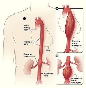 Aortic Aneurysm image 1