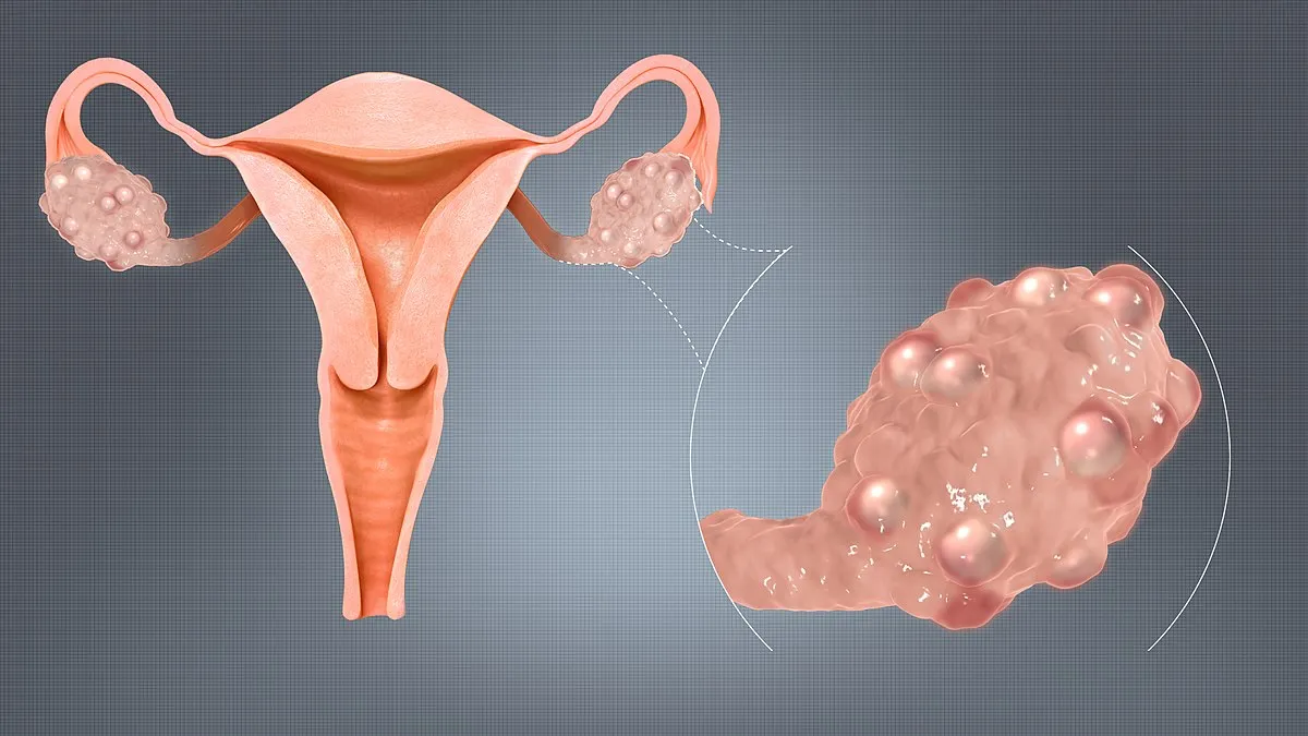 PCOS (Polycystic Ovary Syndrome) treatment image 1