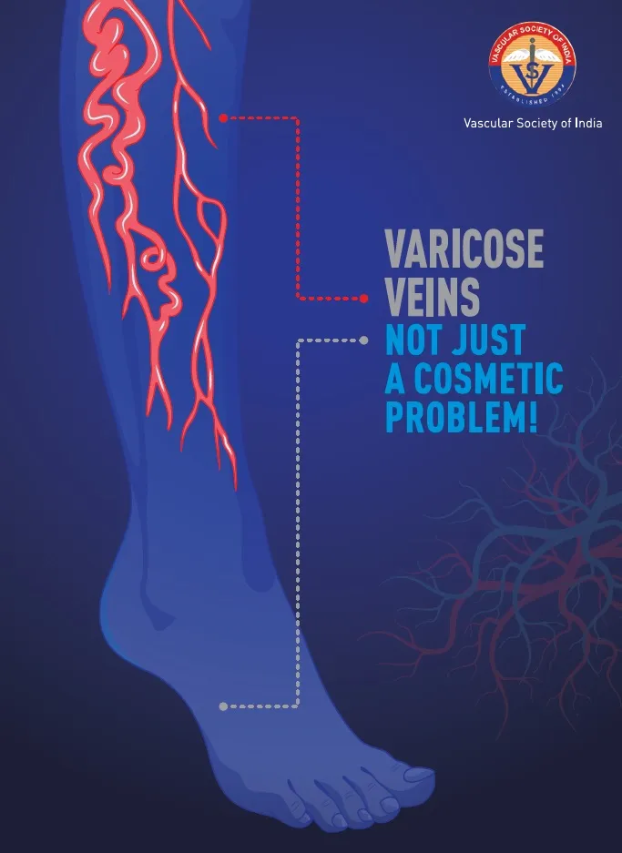 Varicose Veins image 1