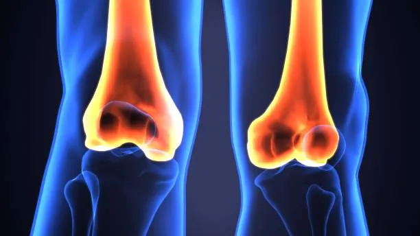 Bone Cyst image 1
