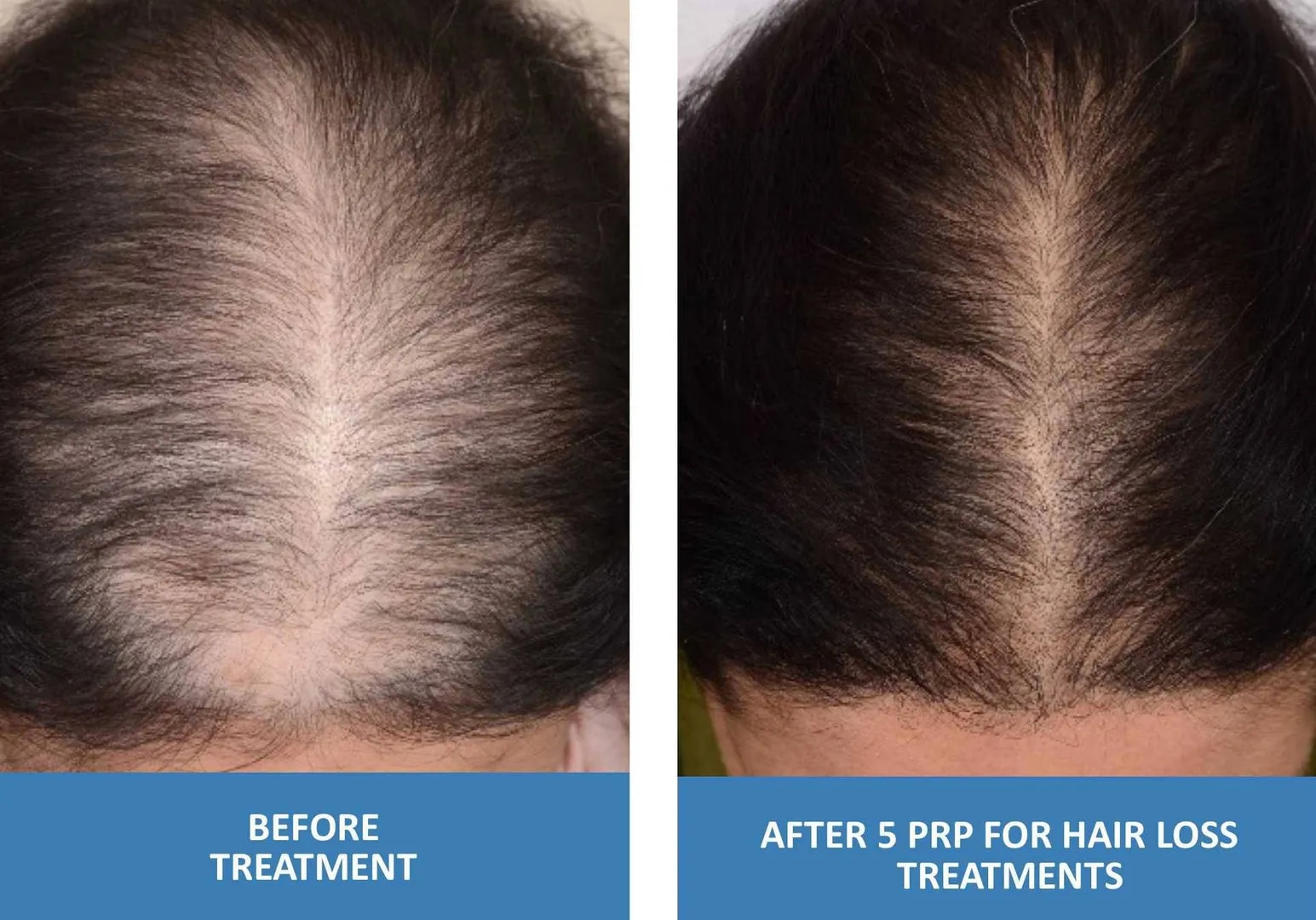 PRP Therapy For Hair image 1