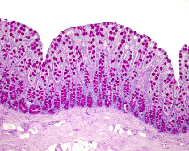 Soft Tissue Tumor image 1