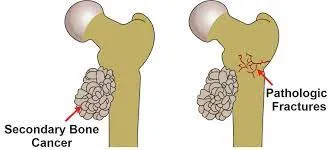 Pathological Fracture image 1