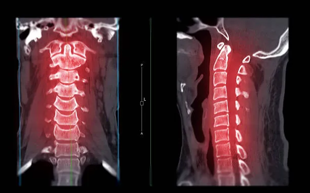 Metastatic Spine disease image 1