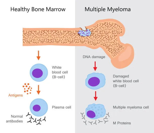 Myeloma image 1