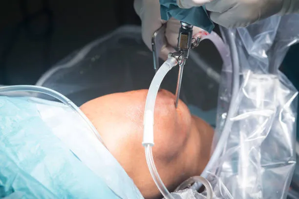 Limb Salvage Surgery​ image 1