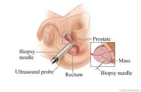 Image Guided Biopsy image 2