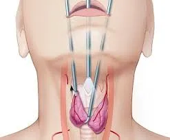 Thyroid Surgery Treatment in Rahatani,Kalewadi,Pimple Saudagar,PCMC image 1