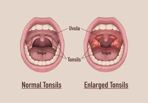 Tonsillectomy Treatment Clinic in Rahatani,Kalewadi,Pimple Saudagar,PCMC image 1