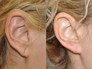 Ear Lobe Repair Clinic in Rahatani,Kalewadi,Pimple Saudagar,PCMC image 1