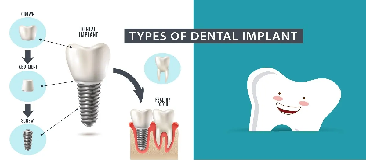 DENTAL IMPLANTS image 1