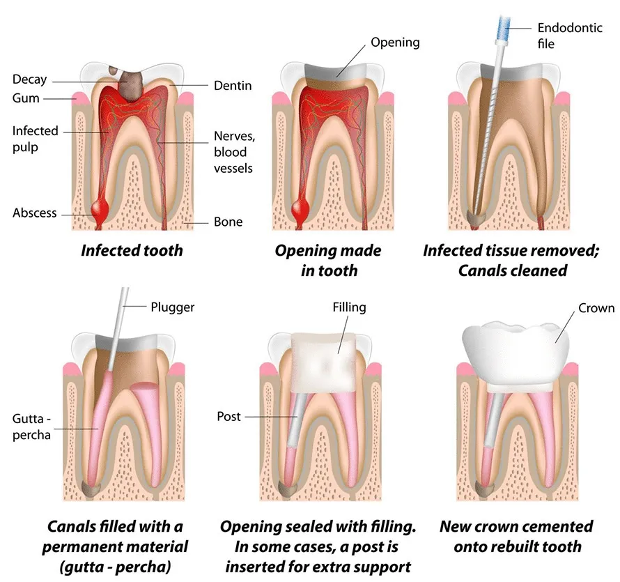 ROOT CANAL TREATMENT image 1